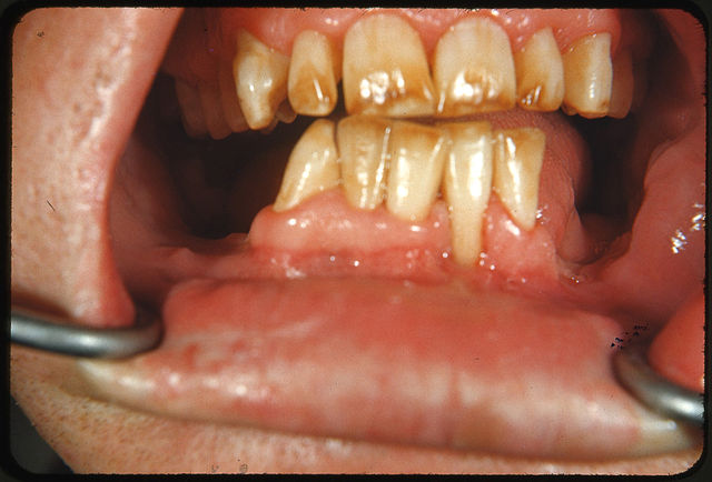 Severe fluorosis: brown discolored and mottled enamel of an individual from a region with high levels of naturally occurring fluoride